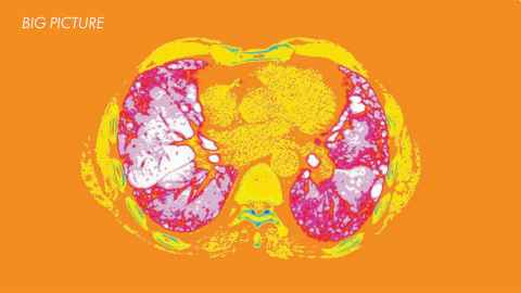 ABI lungs imaging